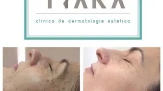 5 motive sa alegi procedura de scoatere alunite cu ajutorul laserului